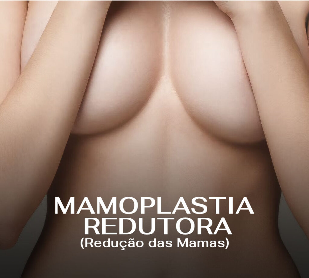 Redução da Mama. Dra. Andréa Carneiro Álvares - Cirurgia Plástica Maringá