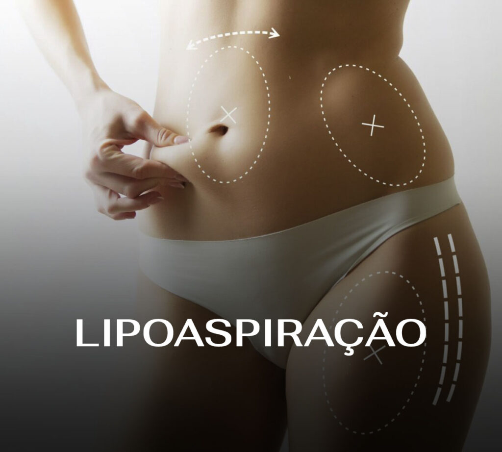 Lipoescultura- Dra. Andréa Carneiro Álvares - Cirurgia Plástica Maringá